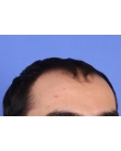 Before Hair Transplant &nbsp;Front